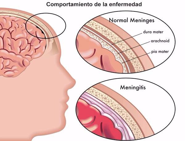 Meningoencefalitis por hongos